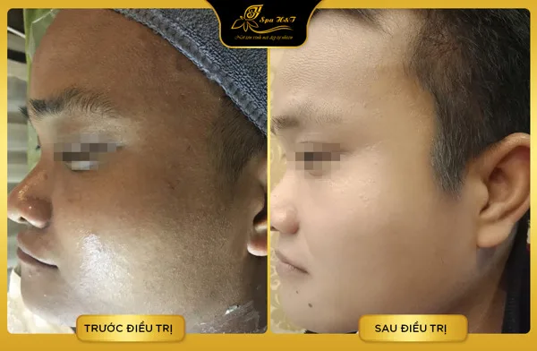 địa chỉ làm trắng da mặt nam giới